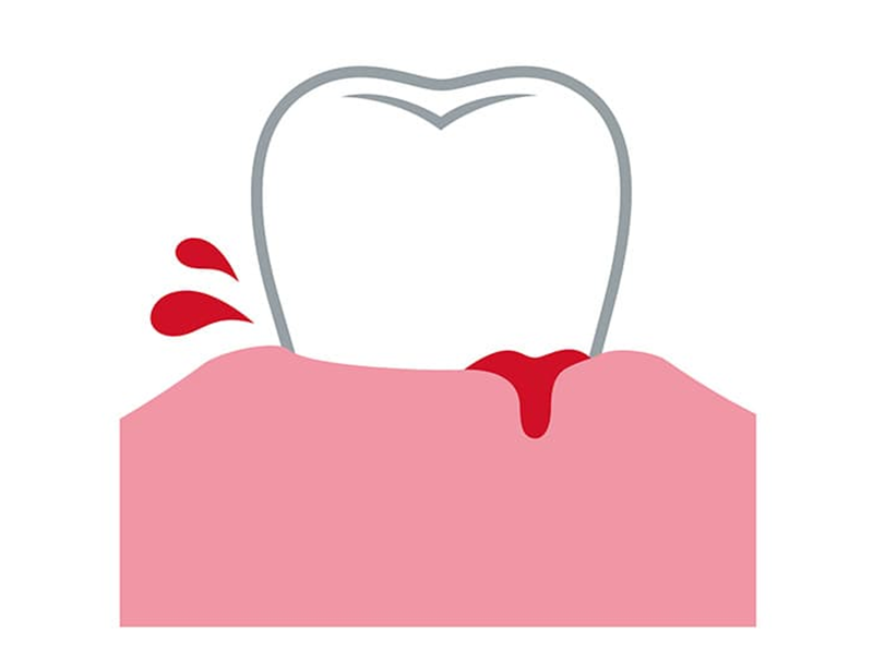 歯肉から血がでる