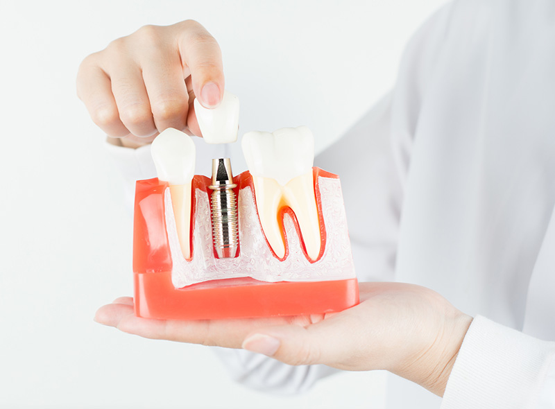 インプラント治療の特徴