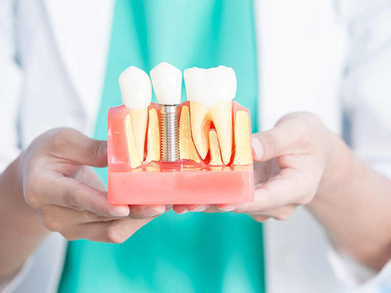 他の歯への影響がない