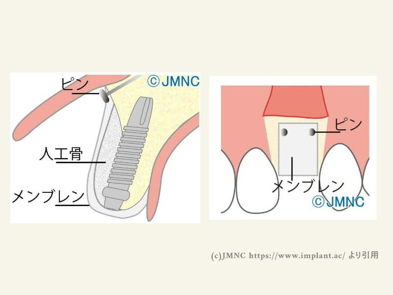 GBR（骨誘導再生法）