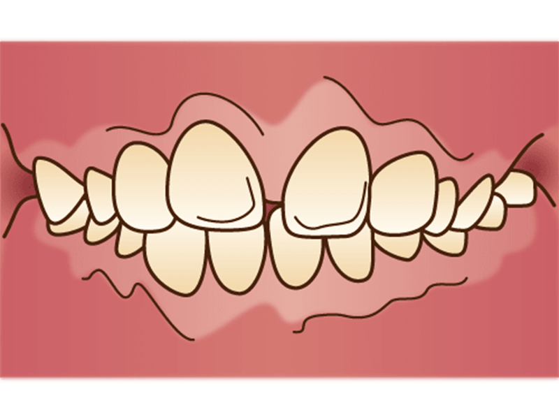 上顎前突