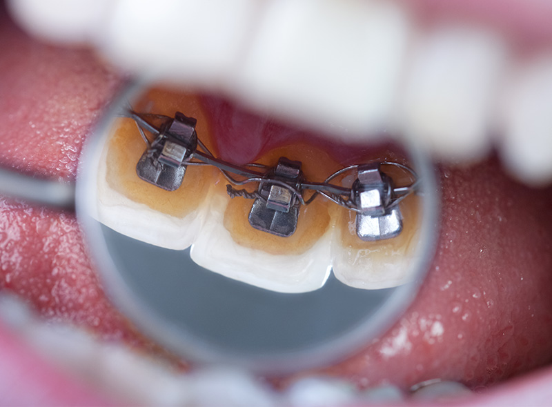 矯正装置の準備