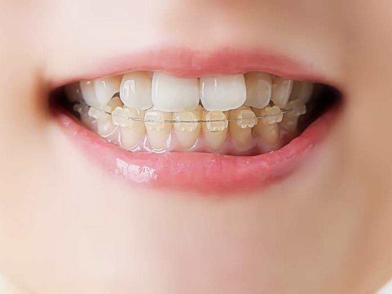 部分矯正のイメージ