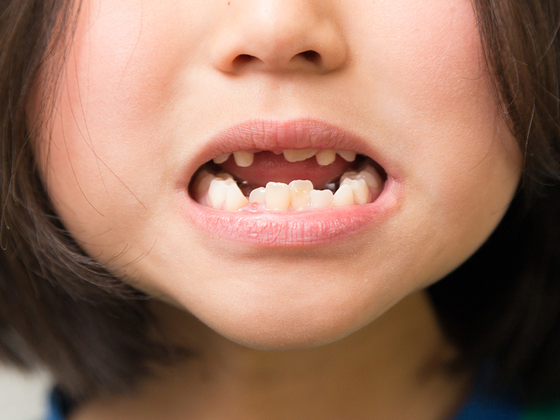 歯並びに影響する癖のイメージ