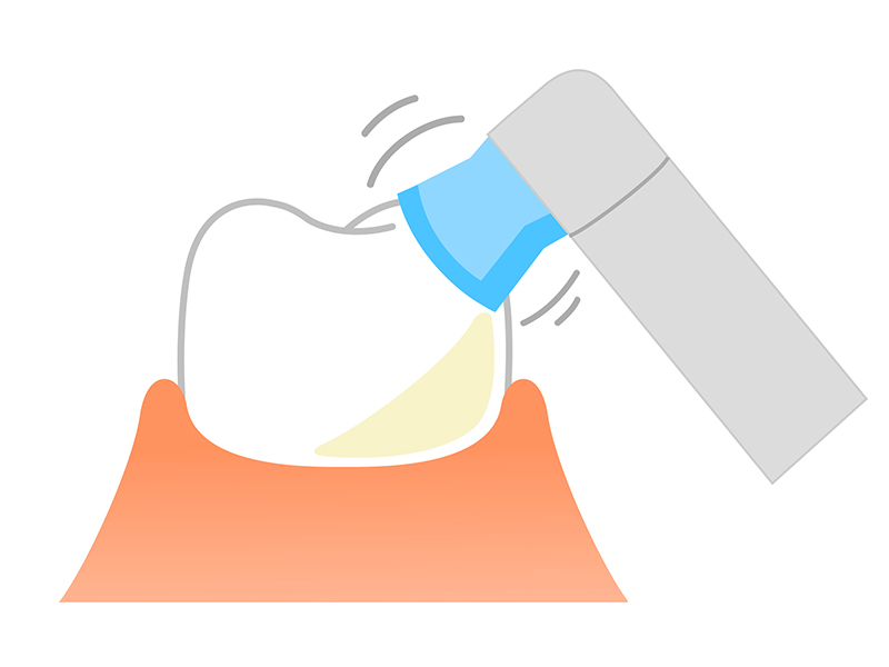 PMTC（プロフェッショナルクリーニング）